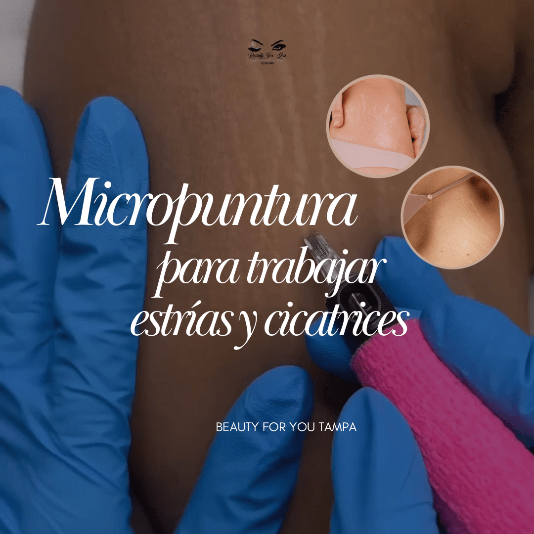 Micropuntura nueva técnica para trabajar estrías y cicatrices